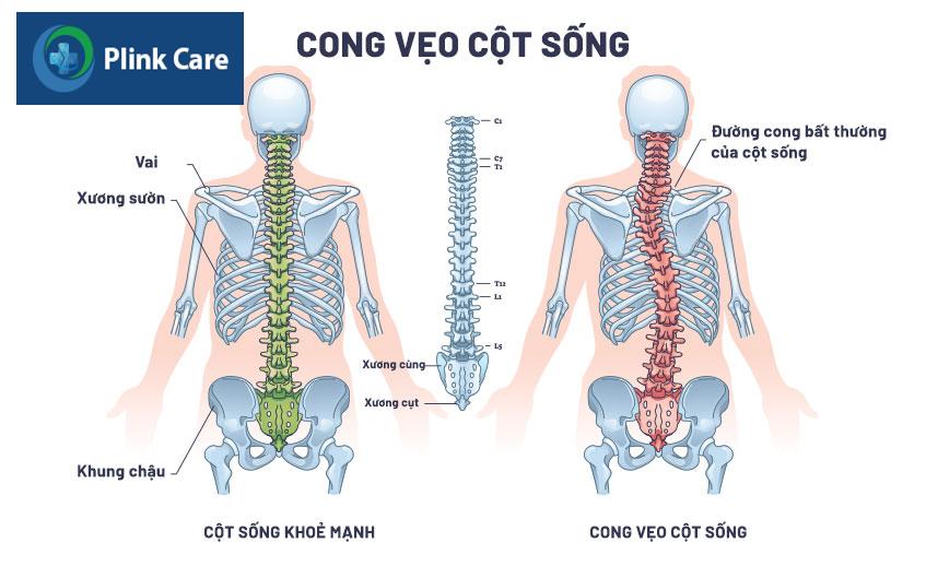cột sống bị cong vẹo