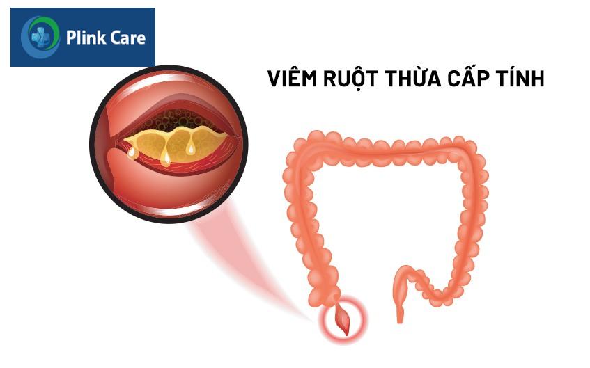 đau bụng bên trái là bị gì