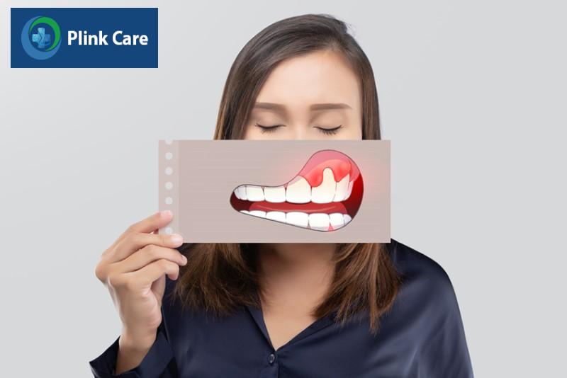 Bệnh viêm nướu có lây không?