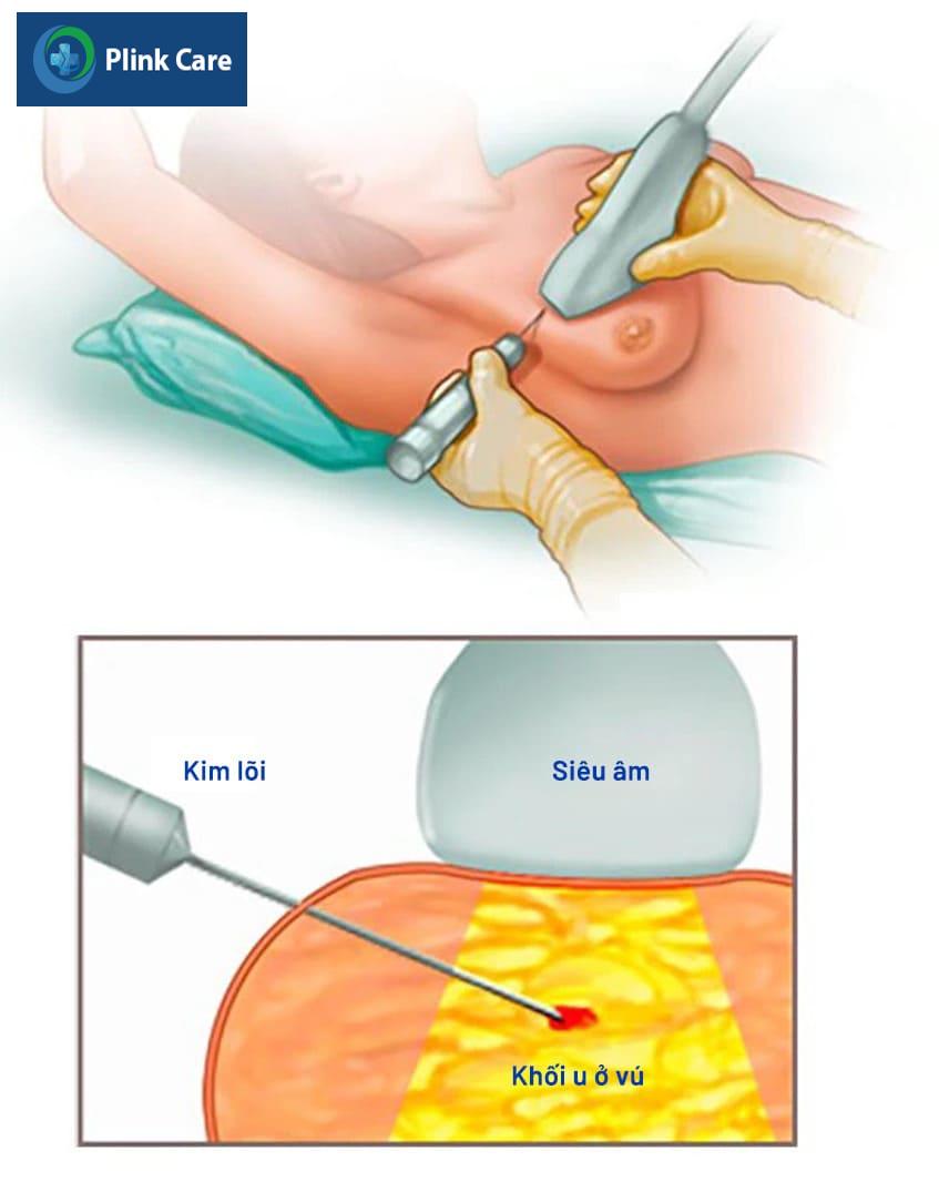 điều trị bệnh Paget vú