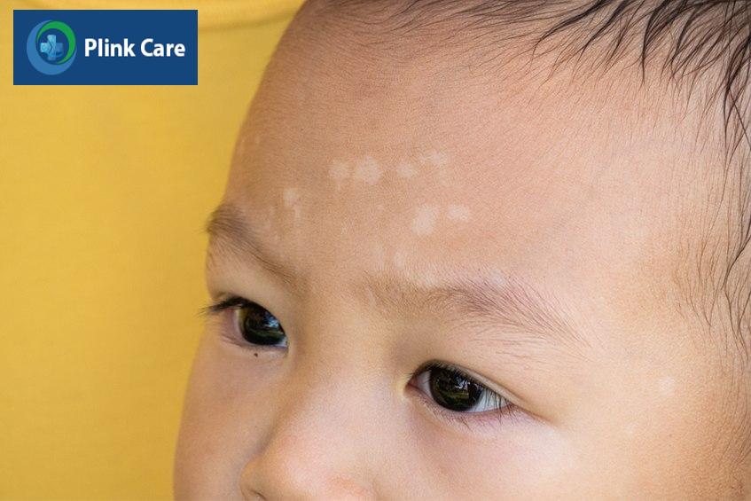 Lang ben trẻ sơ sinh do nhiễm nấm Malassezia 