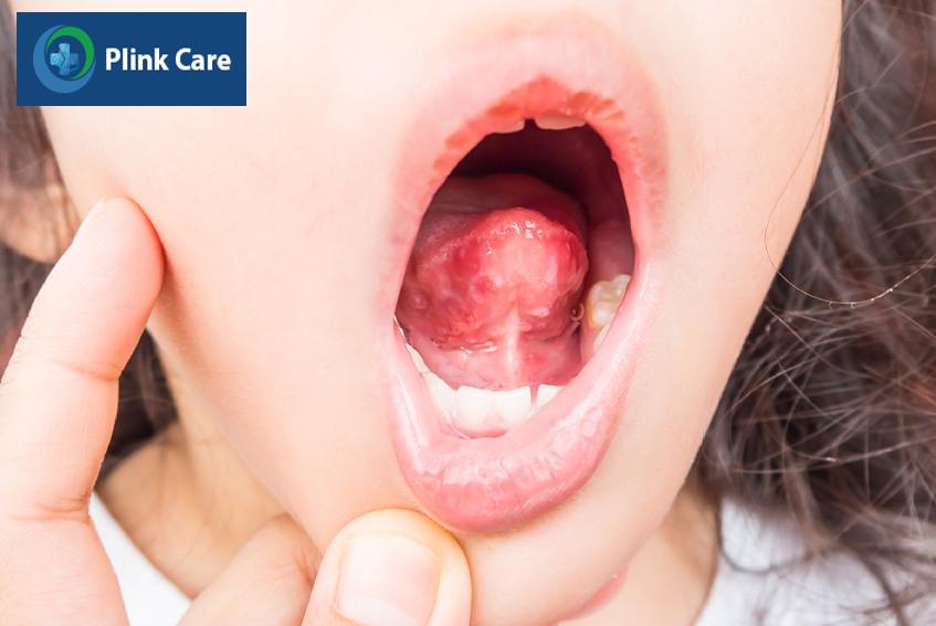 Miệng trẻ nổi nhiều mụn nước do bệnh tay chân miệng