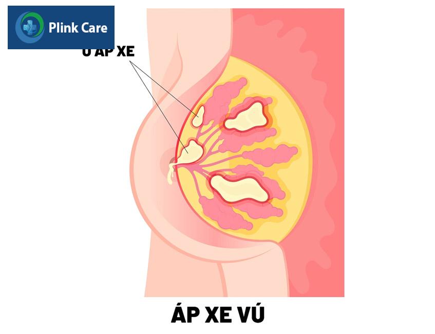 mủ trong ổ áp xe