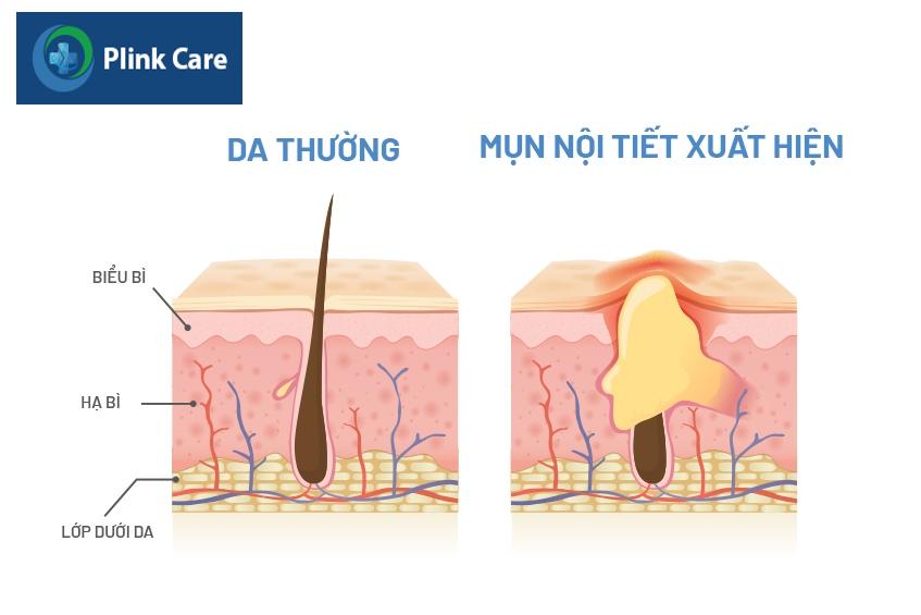 Mụn ở quai hàm do cơ thể sản xuất nội tiết tố quá mức