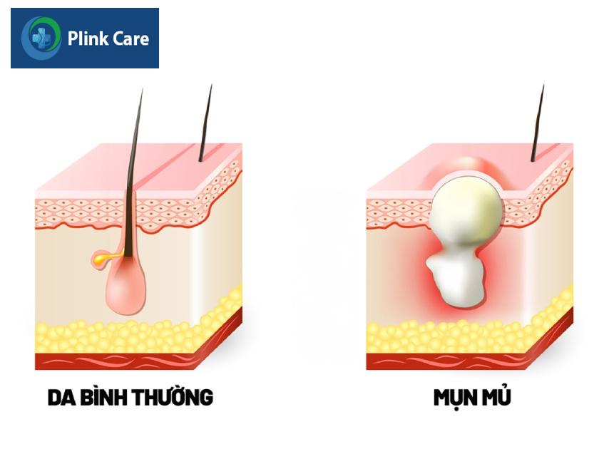 mụn trứng cá hình thành như thế nào