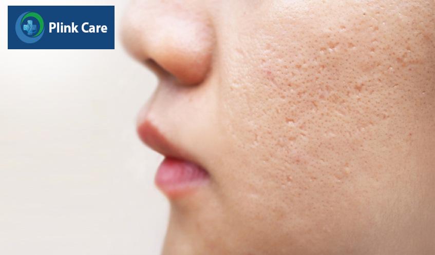mụn trứng cá nặng có để lại sẹo không