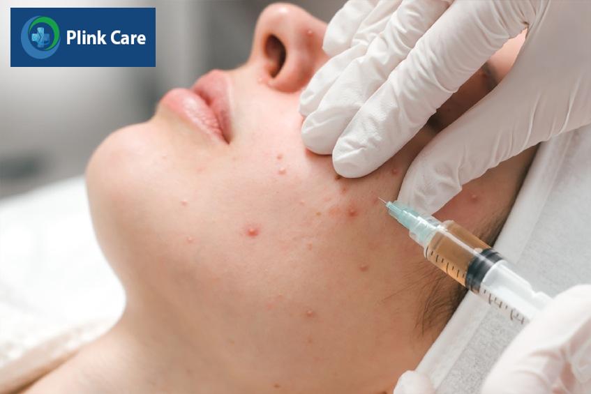 mụn trứng cá nặng điều trị