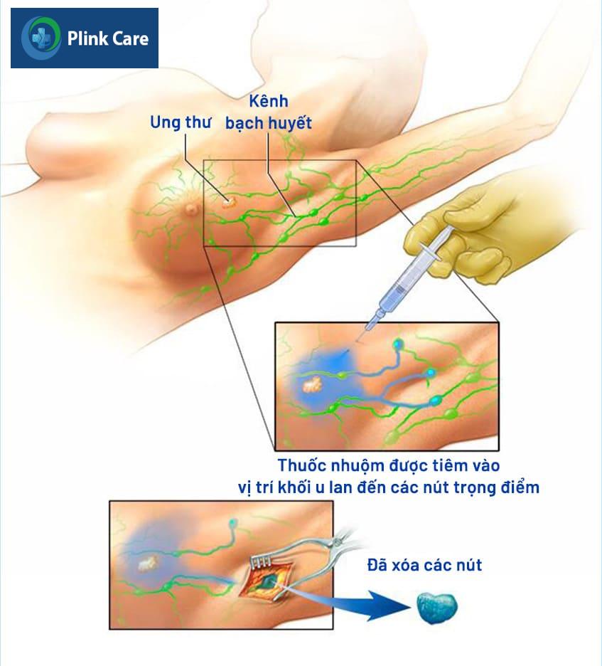 Nguyên nhân bệnh Paget vú