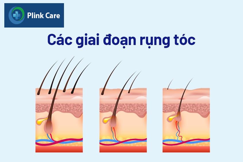 nguyên nhân rụng tóc nhiều bất thường