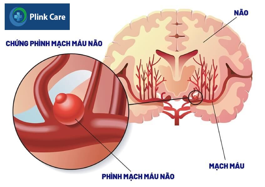 phình động mạch não