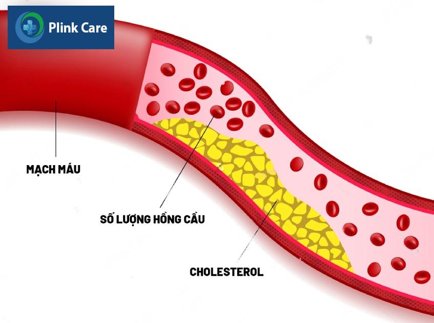 Rối loạn mỡ máu là bệnh gì? Bị rối loạn mỡ máu có nguy hiểm không?