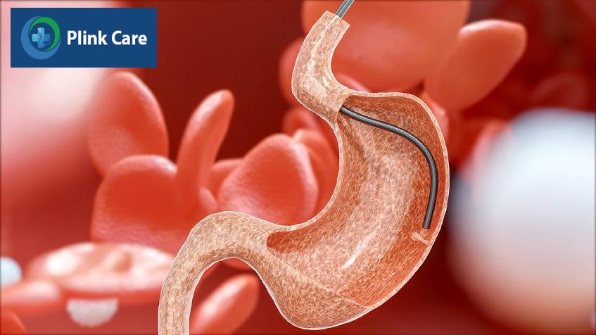 sinh thiết polyp dạ dày là gì