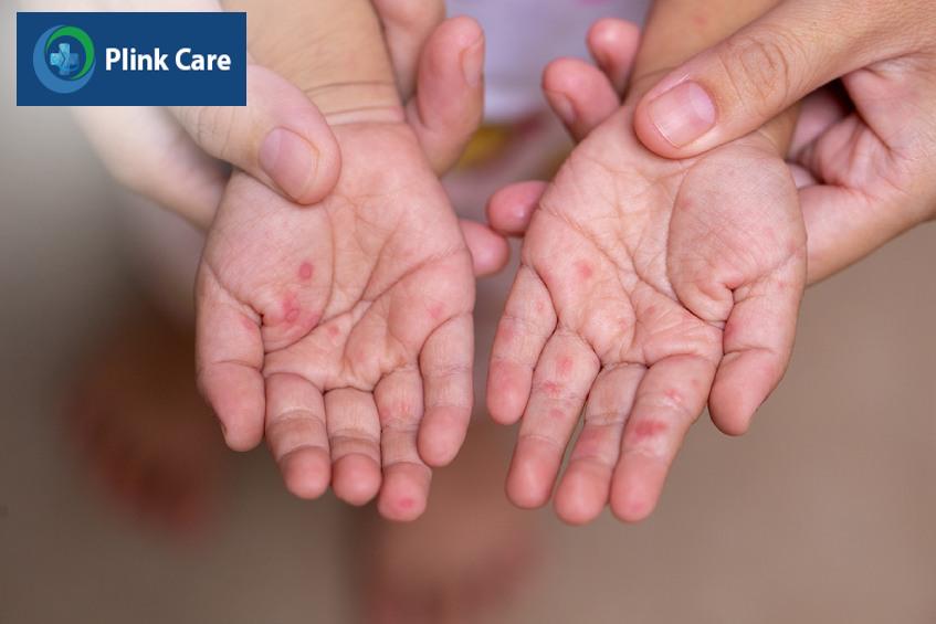 Tay chân miệng được chia làm 4 cấp độ