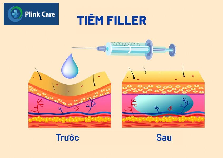 tiêm filler cằm có tác dụng gì