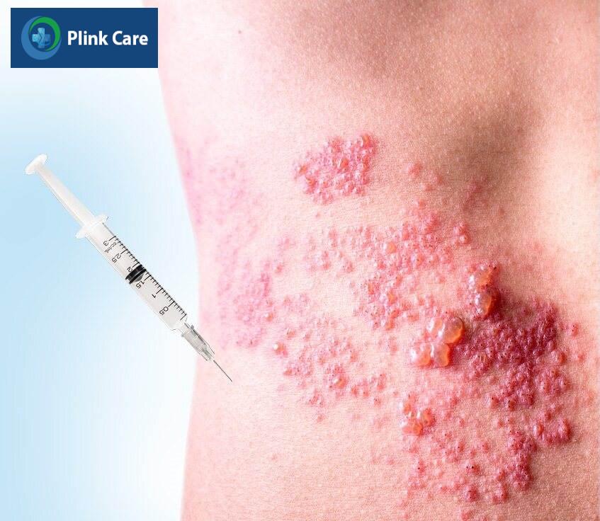 tiêm vaccin phòng ngừa biến chứng zona thần kinh