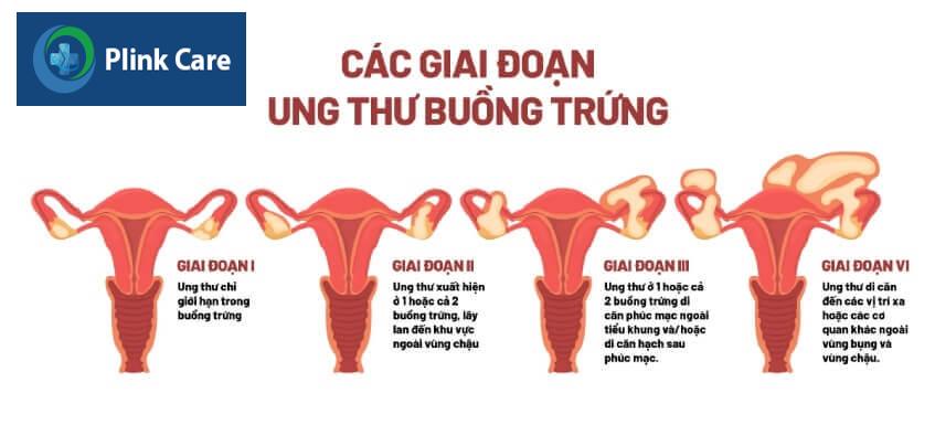 tiên lượng ung thư buồng trứng theo giai đoạn