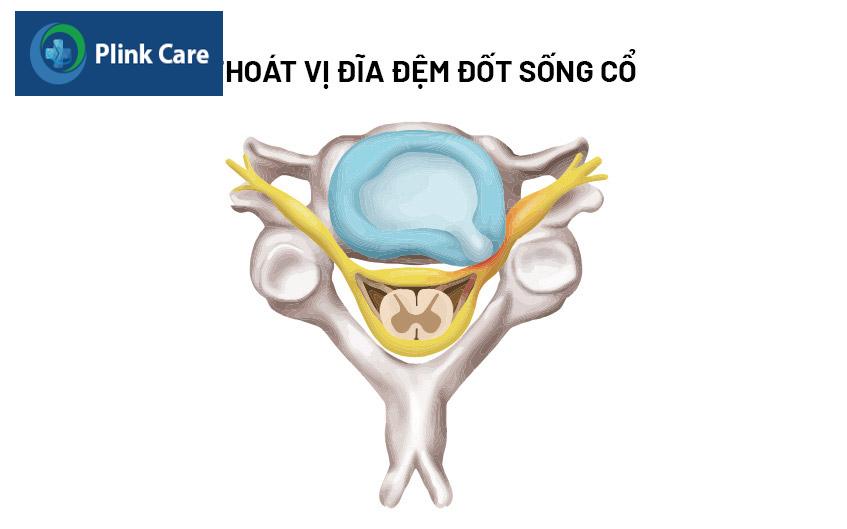 tình trạng thoát vị đốt sống cổ