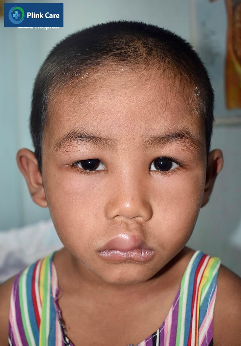 Trẻ bị sưng phù mắt, môi do hội chứng thận hư
