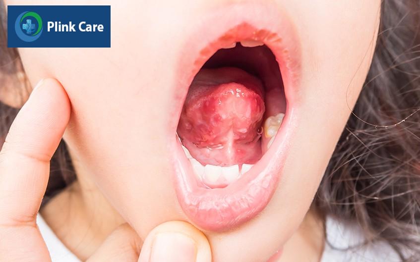 Trẻ xuất hiện các vết loét ở vùng miệng