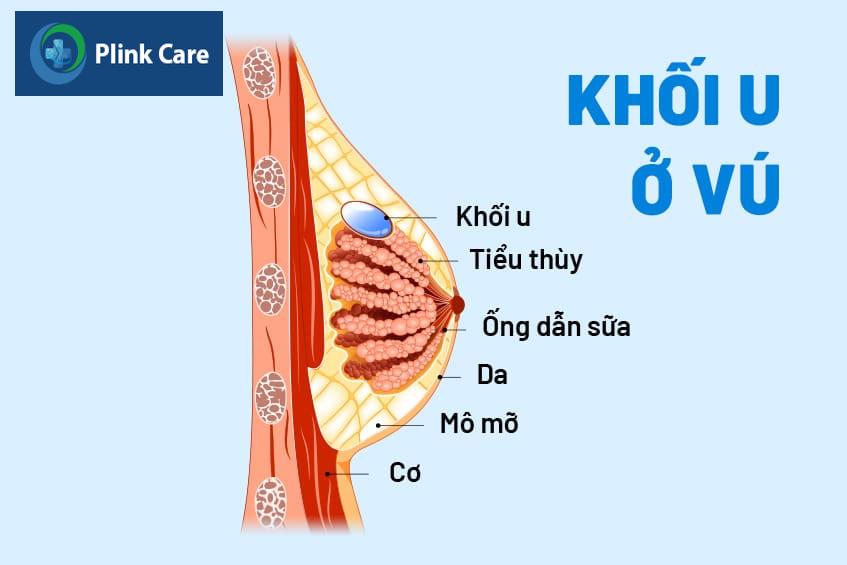 Triệu chứng khối u ở vú