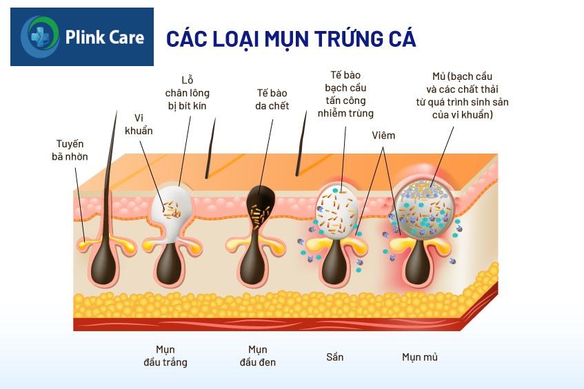 Triệu chứng mụn nội tiết ở nam