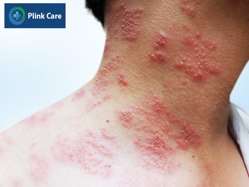 triệu chứng zona thần kinh