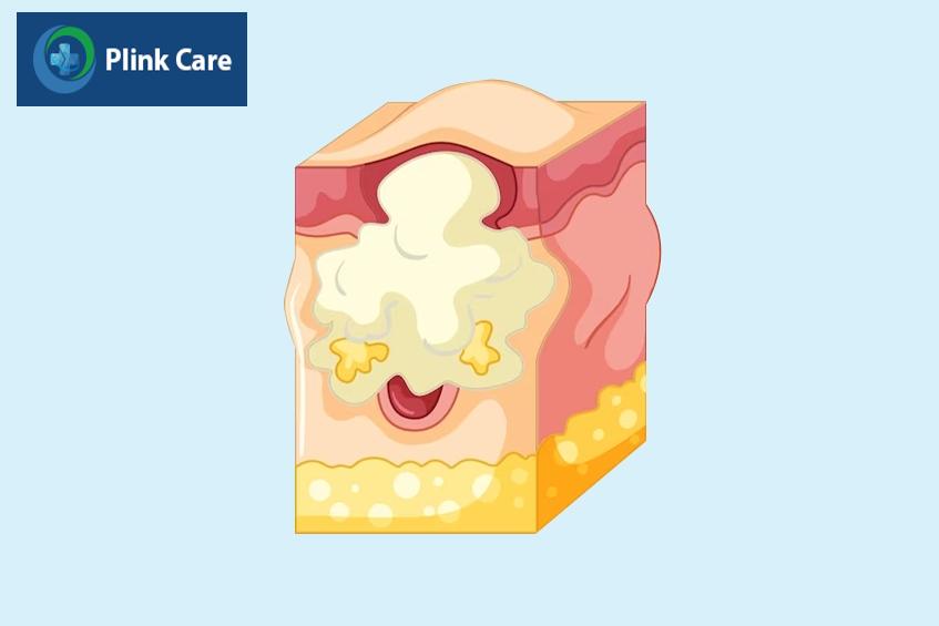 Tuyến bã nhờn hoạt động quá mức