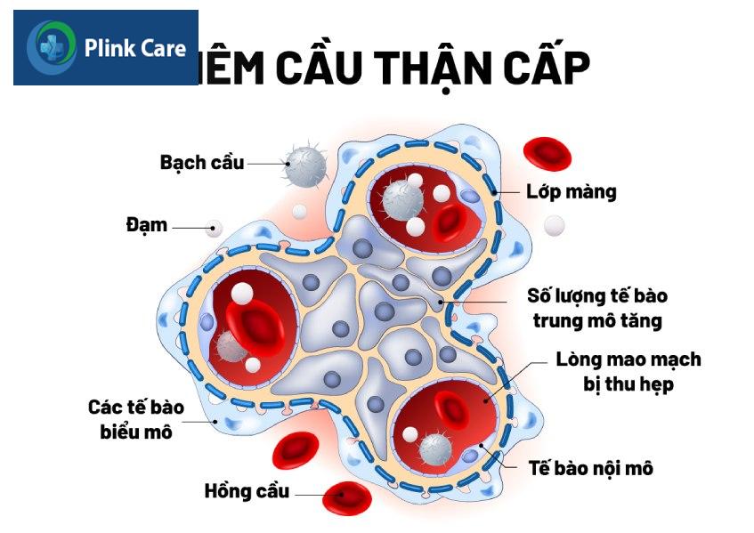Viêm cầu thận cấp ở trẻ