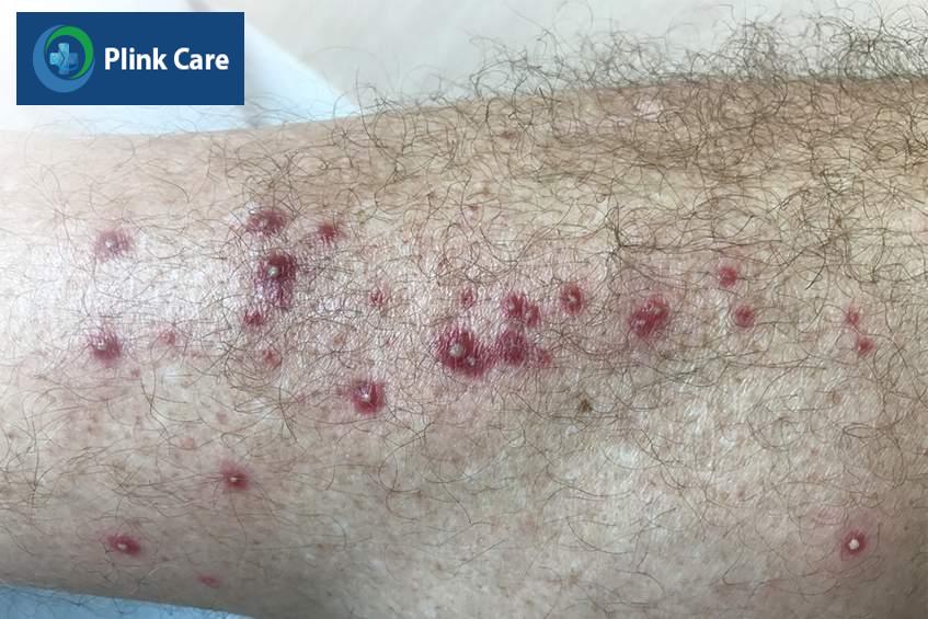 viêm nang lông xảy ra ở mọi vị trí