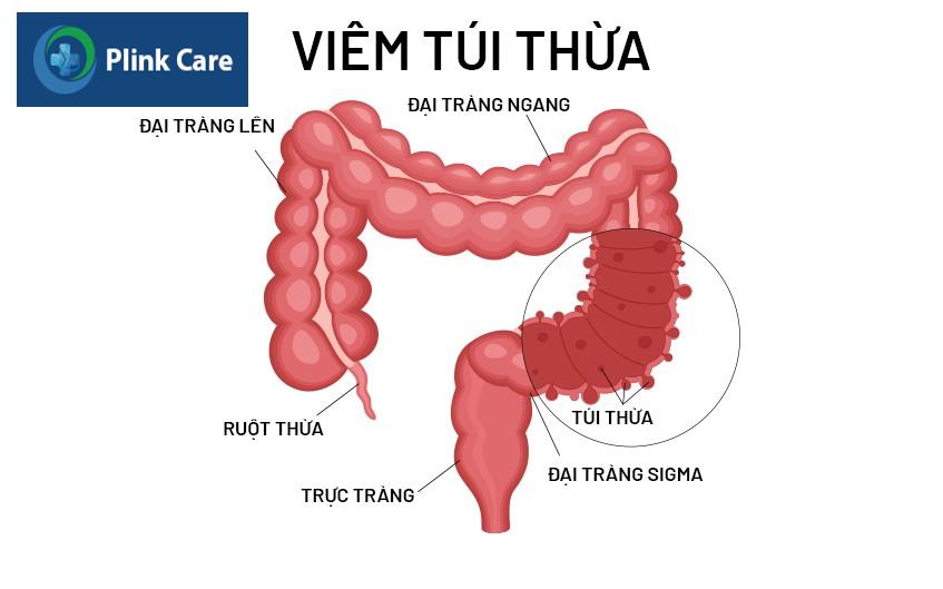 viêm túi thừa là gì