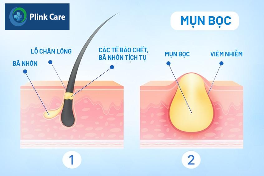 Bã nhờn khiến lỗ chân lông bít tắc, gây nổi mụn bọc
