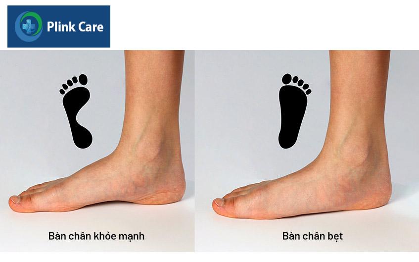 bàn chân bẹt và bàn chân khỏe mạnh