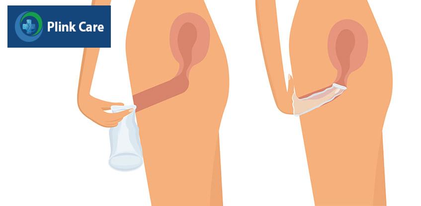 bao được đưa sâu vào âm đạo