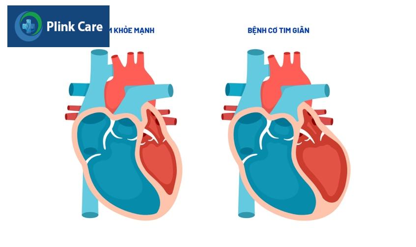 Bệnh cơ tim giãn khiến các buồng tim bị mỏng và căng ra