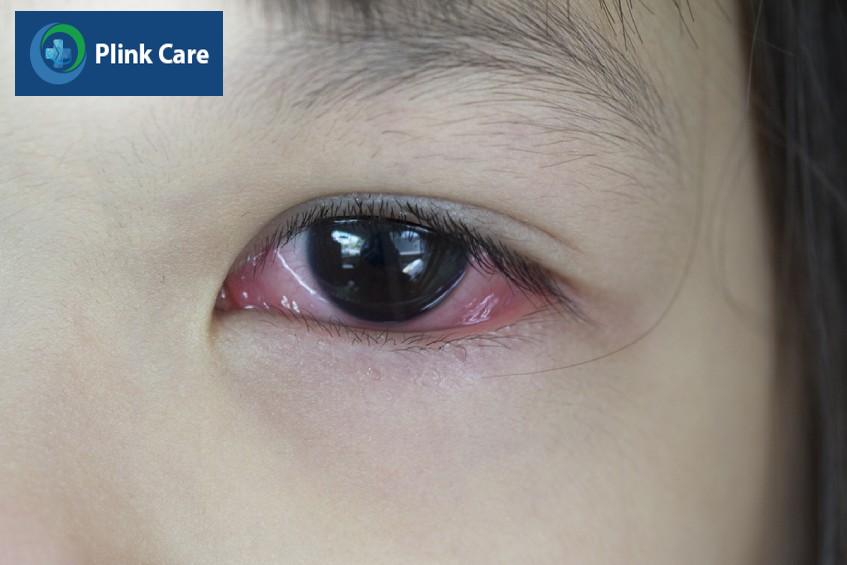 Bệnh đau mắt đỏ khiến mắt sưng đỏ, khó chịu