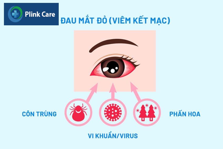 bệnh đau mắt đỏ