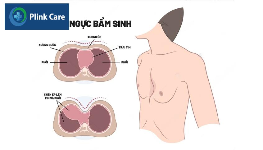 Bệnh lõm ngực nặng có thể gây chèn ép các bộ phận bên trong như tim, phổi