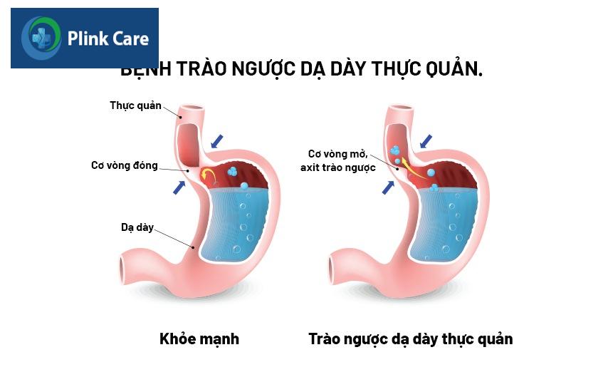 bệnh lý tiêu hóa