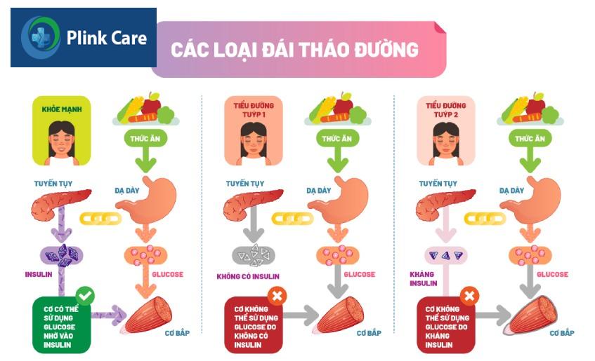 Bệnh tiểu đường ở trẻ em được chia làm hai loại chính