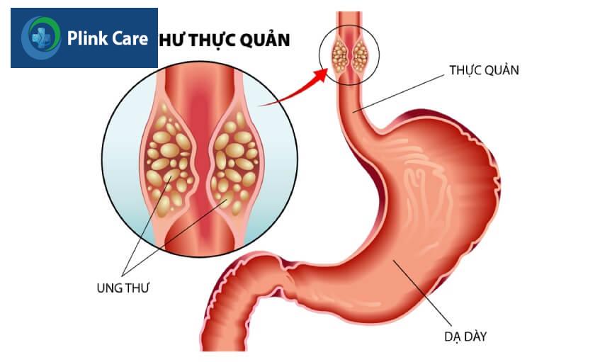 bệnh ung thư thực quản giai đoạn 2