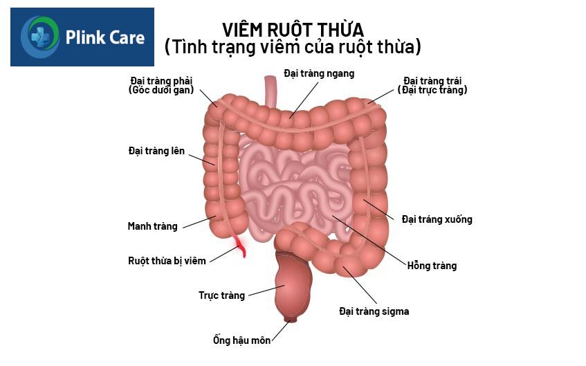 bệnh viêm ruột thừa