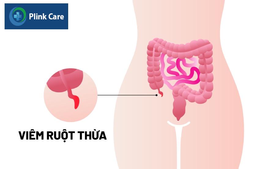 bị viêm ruột thừa