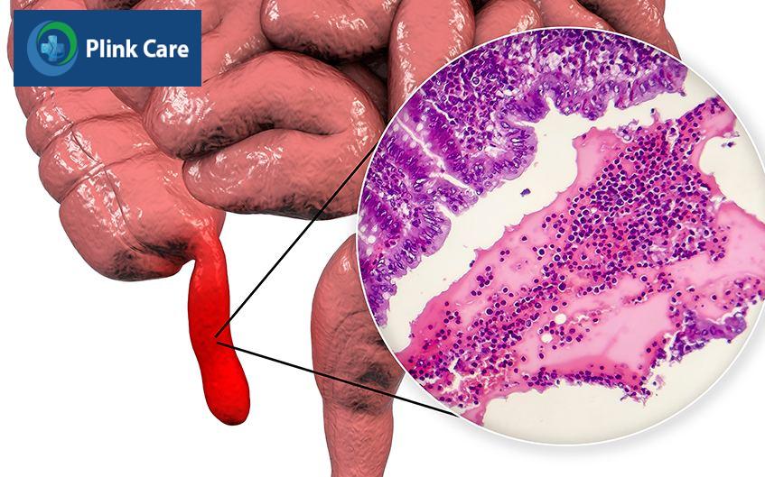 bị viêm ruột thừa