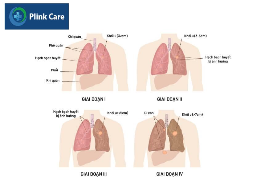 các giai đoạn bệnh ung thư phổi
