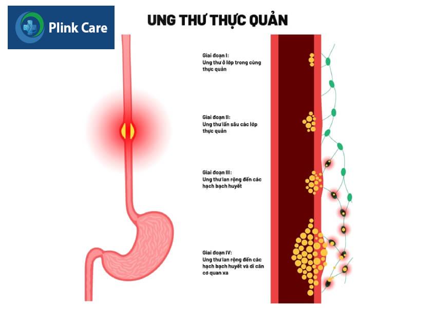 các giai đoạn ung thư thực quản