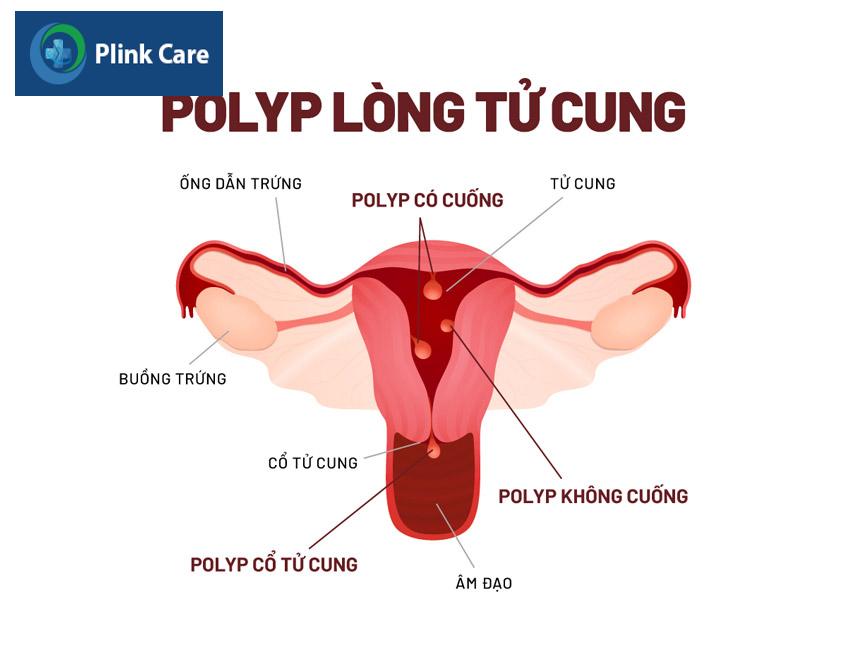 các vị trí xuất hiện polyp tử cung