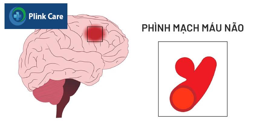 cách điều trị bệnh phình mạch máu não