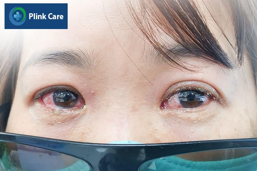 cách trị đau mắt đỏ