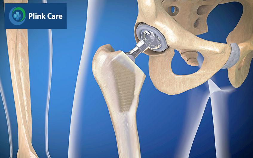 cần biết gì về mổ thay thế khớp háng