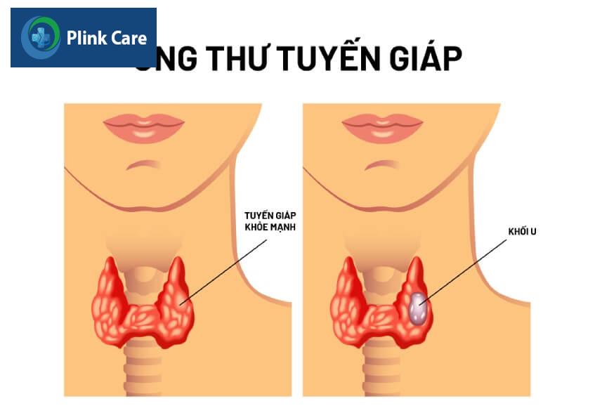 chẩn đoán ung thư tuyến giáp thể nang